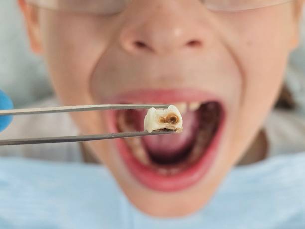 Best Emergency Dental Extractions in Kentland, IN